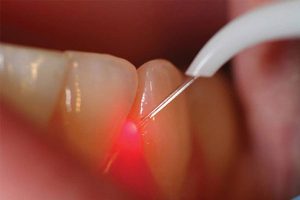 Estrazione dentale personalizzata
