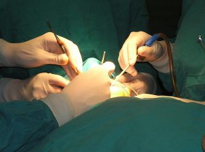 Intervento chirurgico per impianti dentali