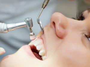 Durata pulizia dentale professionale