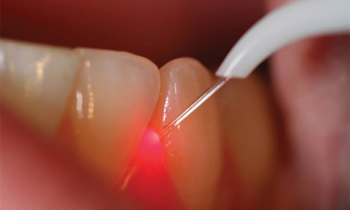 Vantaggi terapia dentale laser