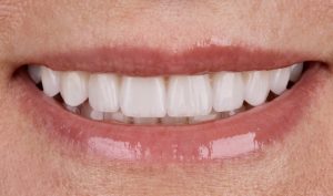 cosa sono le faccette dentali
