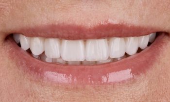 cosa sono le faccette dentali