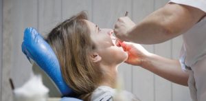 Come evitare la perimplantite