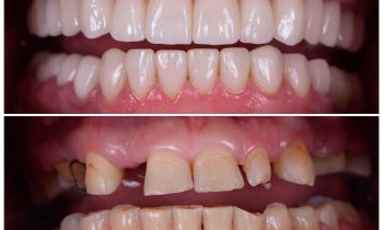 Impianti dentali: sei un candidato ideale?