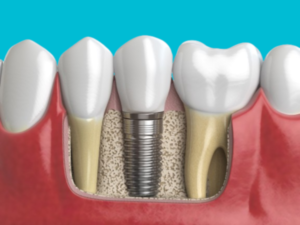 Guida completa al costo degli impianti dentali nel 2023