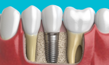 Guida completa al costo degli impianti dentali nel 2023
