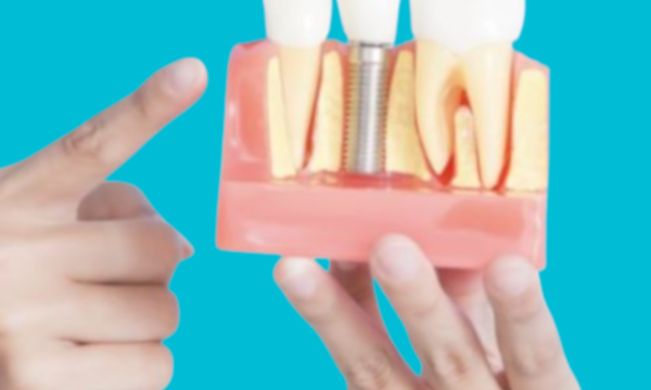 Impianto dentale per un dente singolo